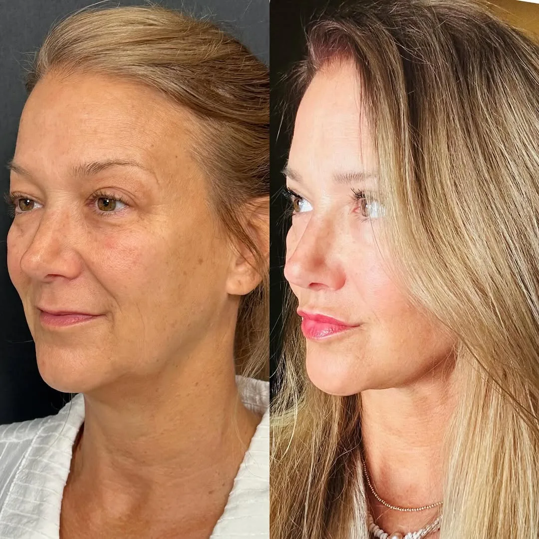 Before and after deep plane facelift — 52-year-old woman, right profile view, 6mo post-op by Dr. Giray Genç