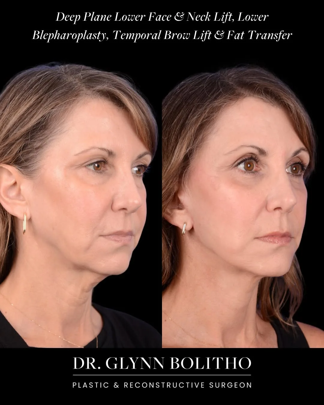 Before and after — Dr. Glynn Bolitho