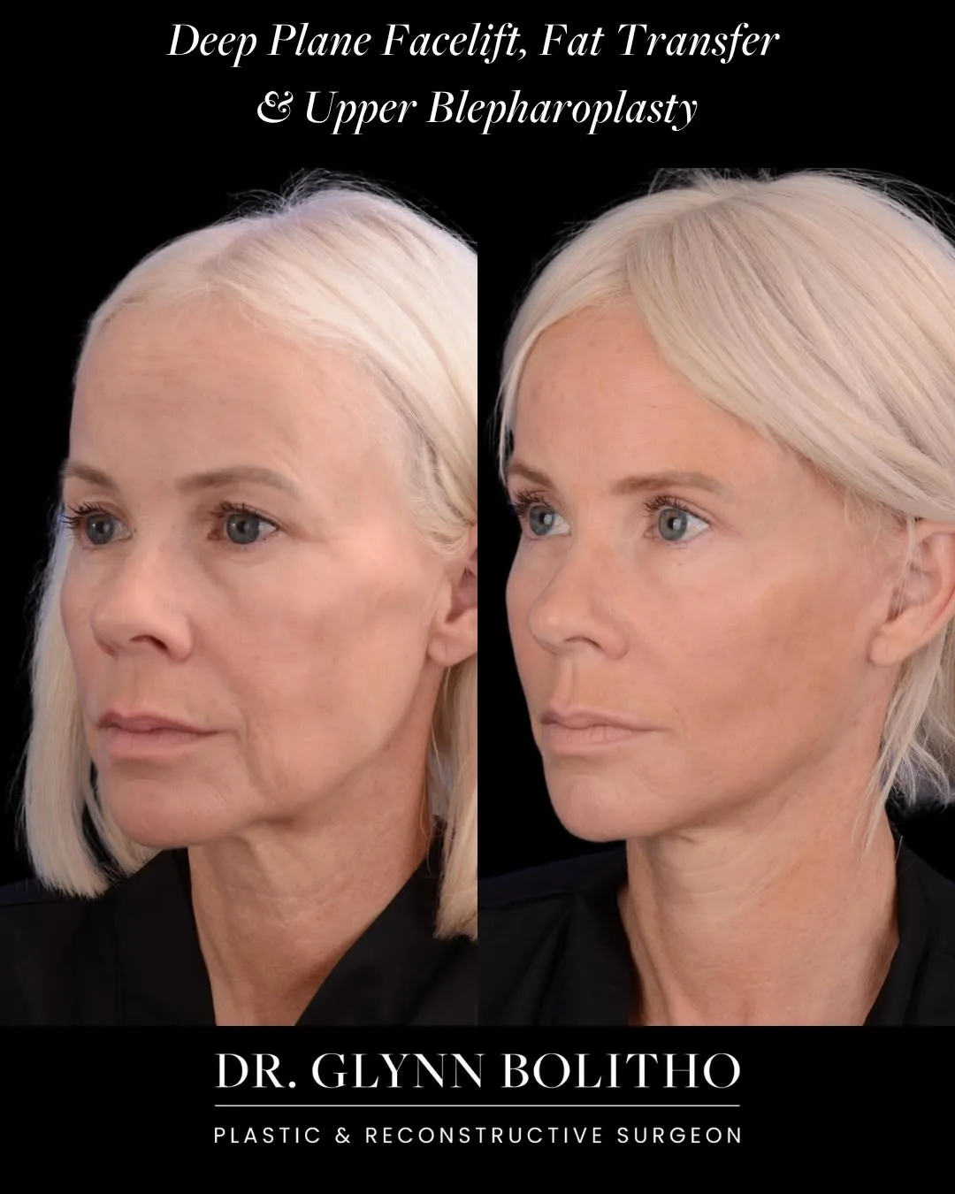 Before and after — Dr. Glynn Bolitho