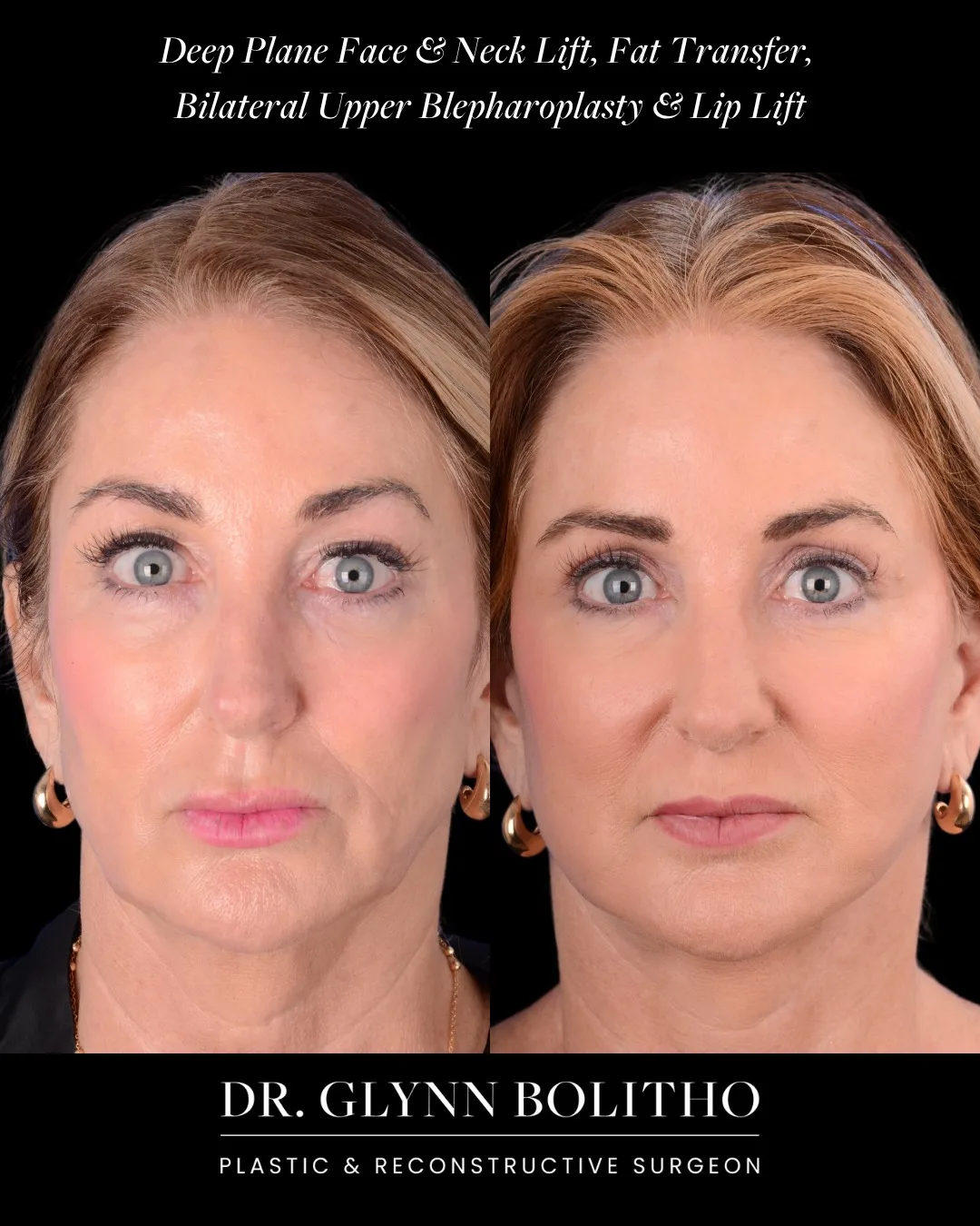 Before and after — Dr. Glynn Bolitho