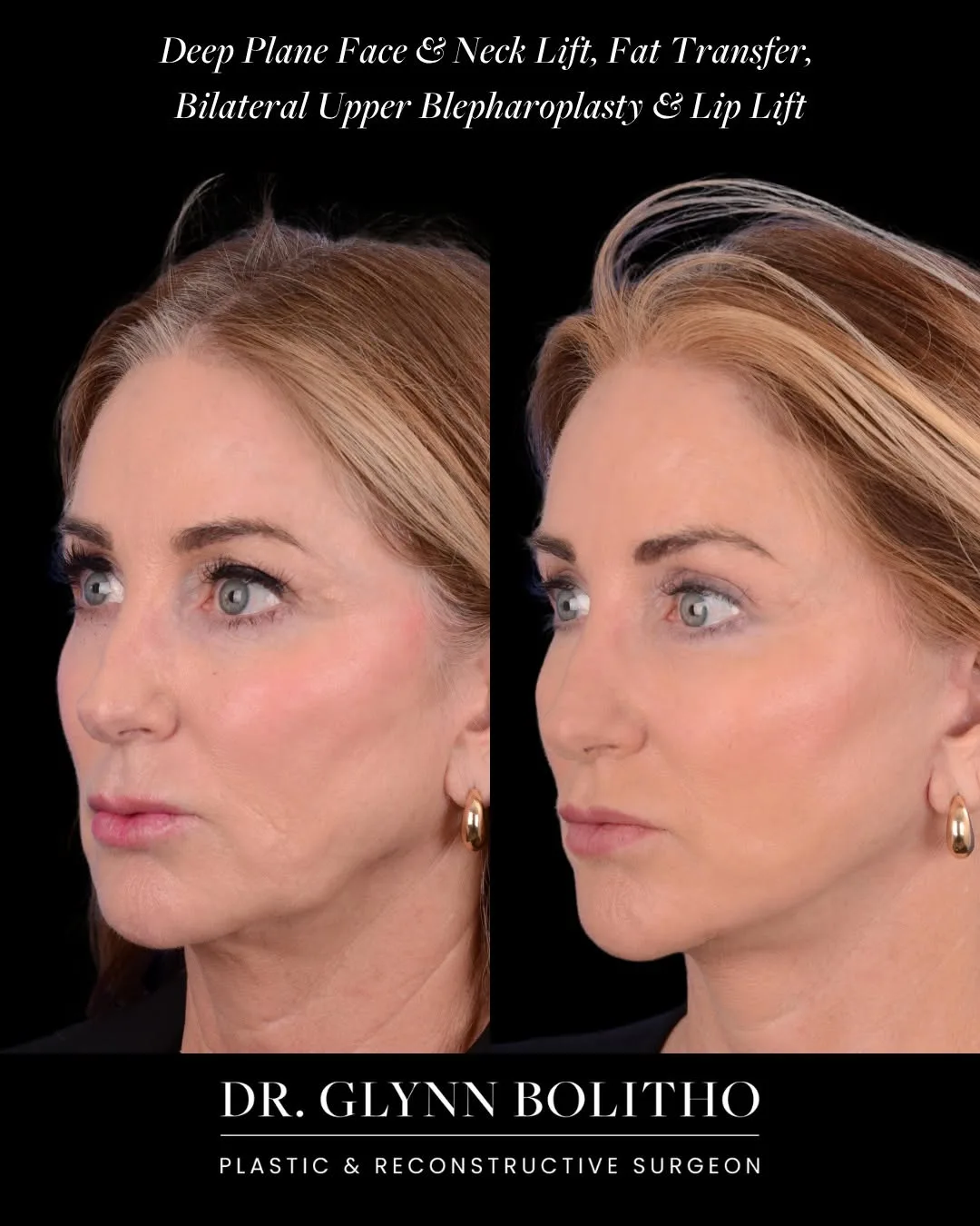 Before and after — Dr. Glynn Bolitho