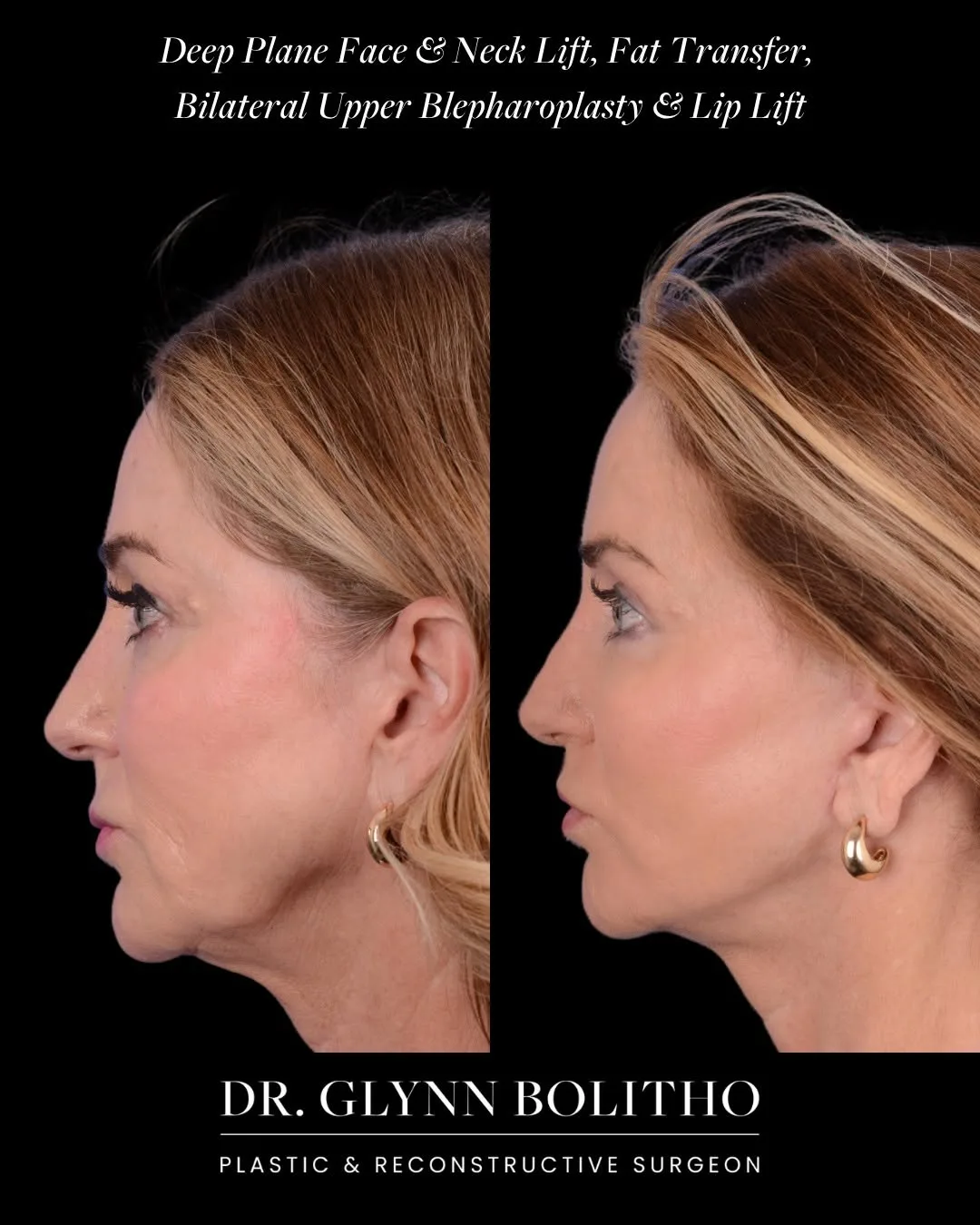 Before and after — Dr. Glynn Bolitho