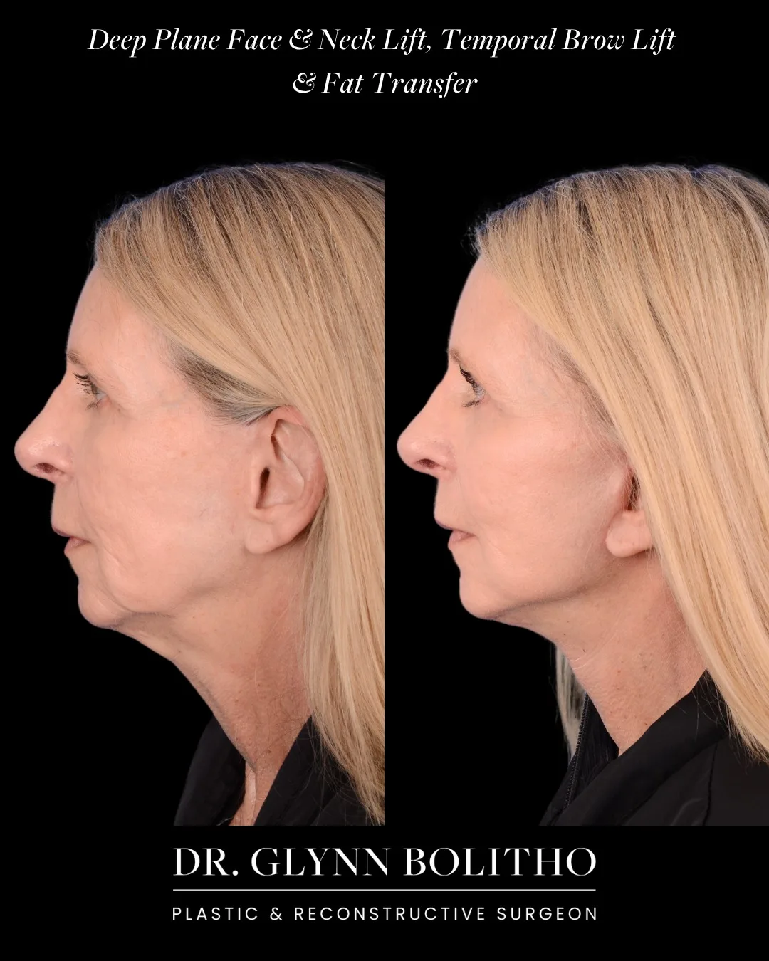 Before and after — Dr. Glynn Bolitho