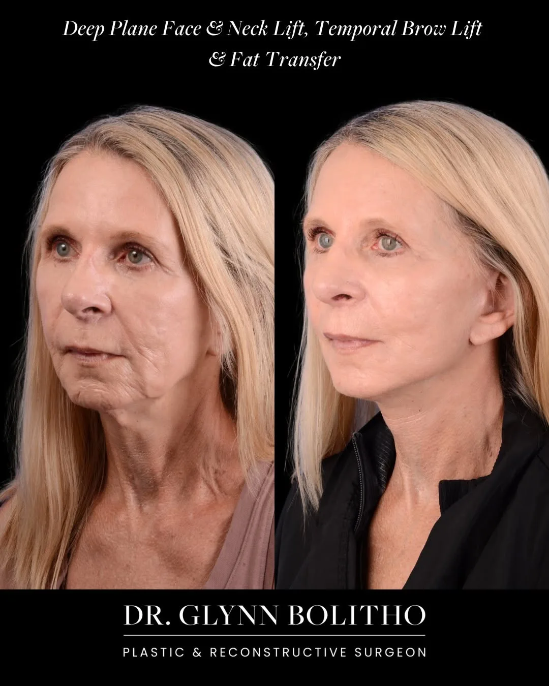 Before and after — Dr. Glynn Bolitho