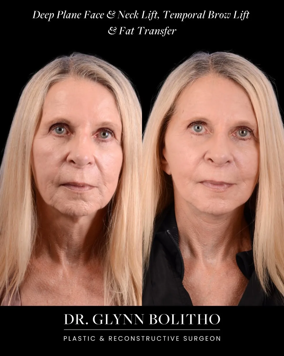 Before and after — Dr. Glynn Bolitho
