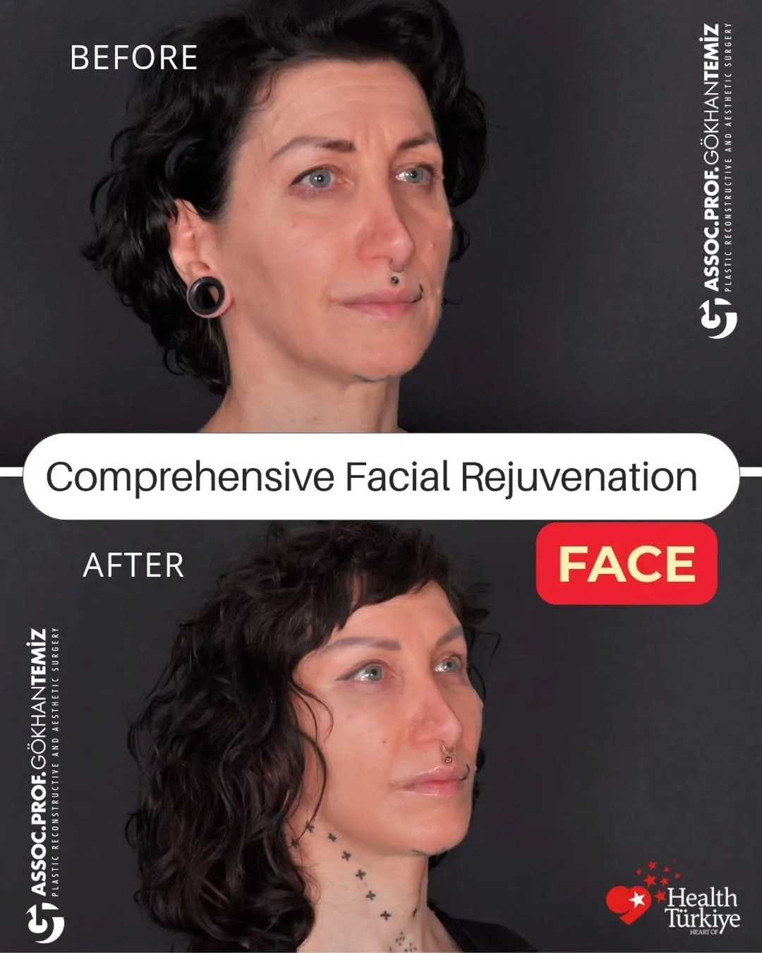 Before and after — Dr. Gökhan Temiz