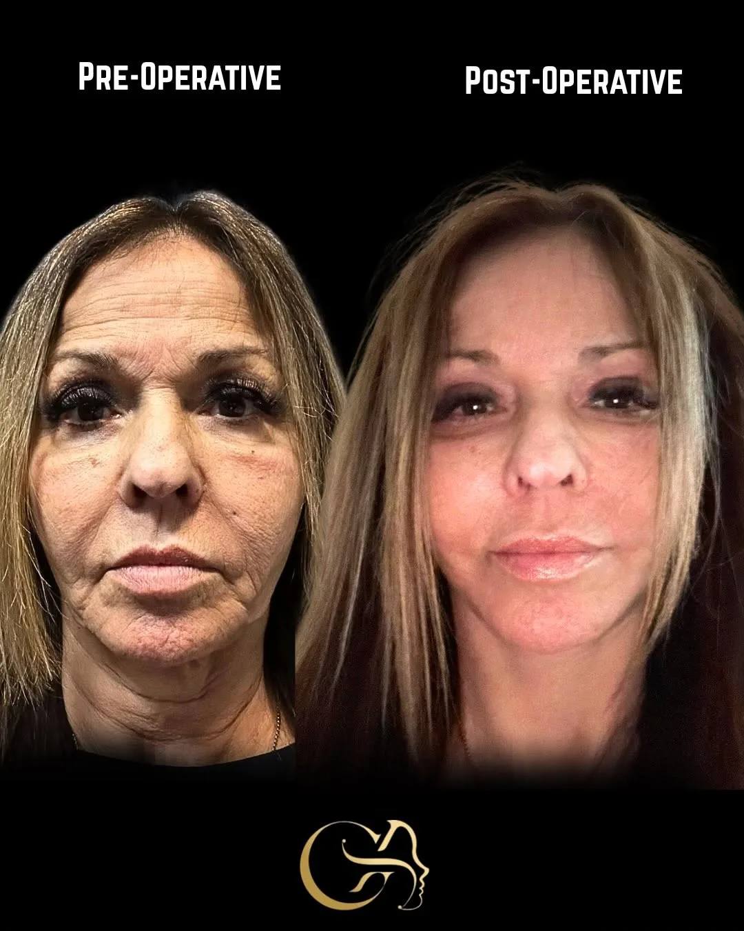 Before and after deep plane facelift — 58-year-old woman, frontal view, 6mo post-op by Dr. Görkem Atsal