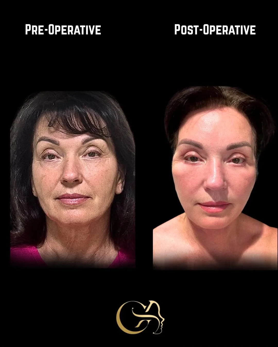 Before and after deep plane facelift — 58-year-old woman, frontal view, 4mo post-op by Dr. Görkem Atsal