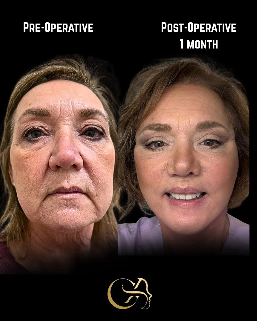 Before and after deep plane facelift — 58-year-old woman, oblique left view, 1mo post-op by Dr. Görkem Atsal