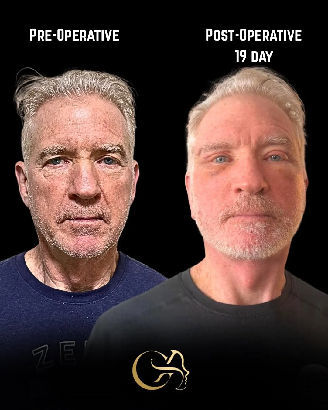 Before and after deep plane facelift — 58-year-old man, frontal view, 3mo post-op by Dr. Görkem Atsal