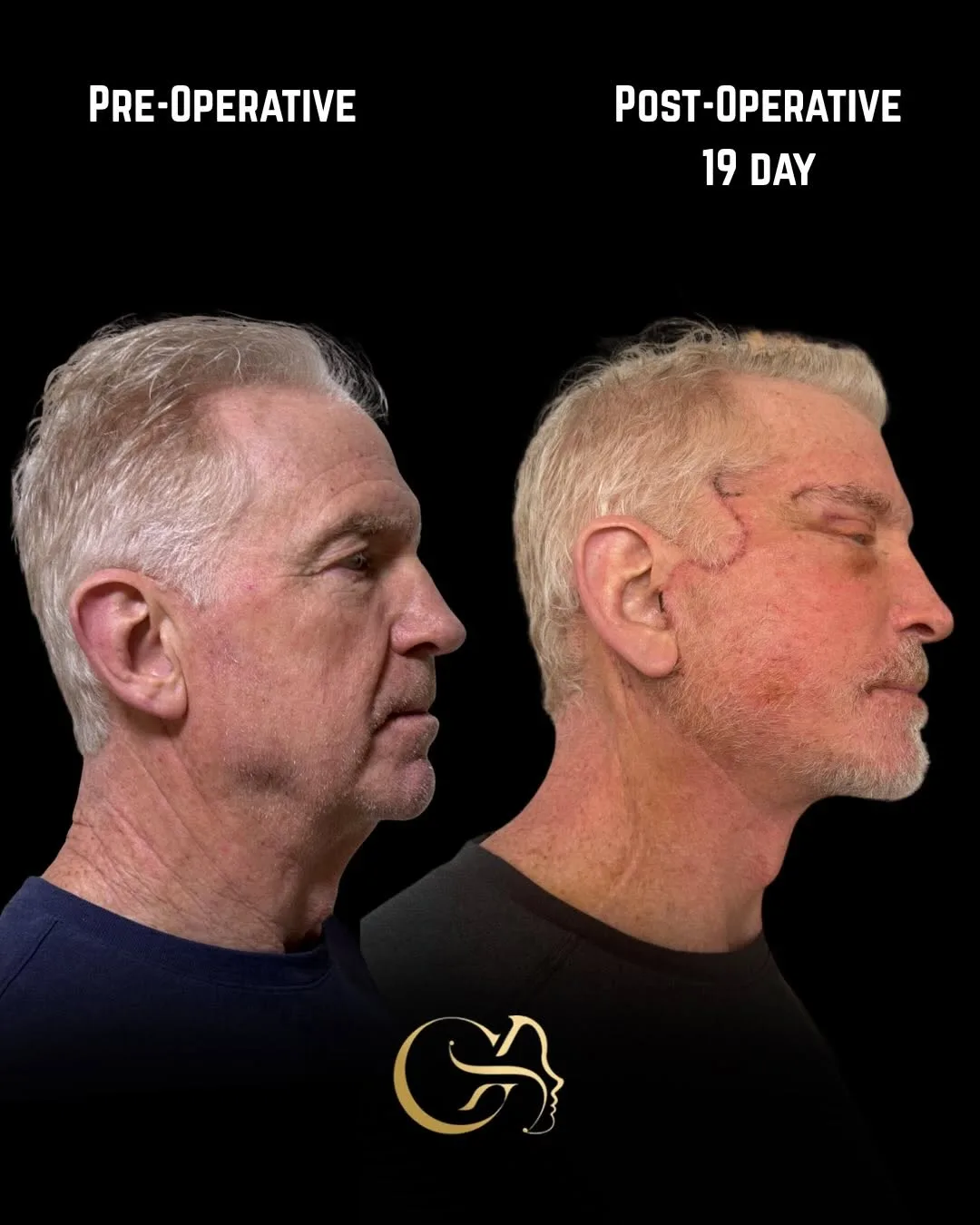 Before and after deep plane facelift — 62-year-old man, right profile view, 3mo post-op by Dr. Görkem Atsal
