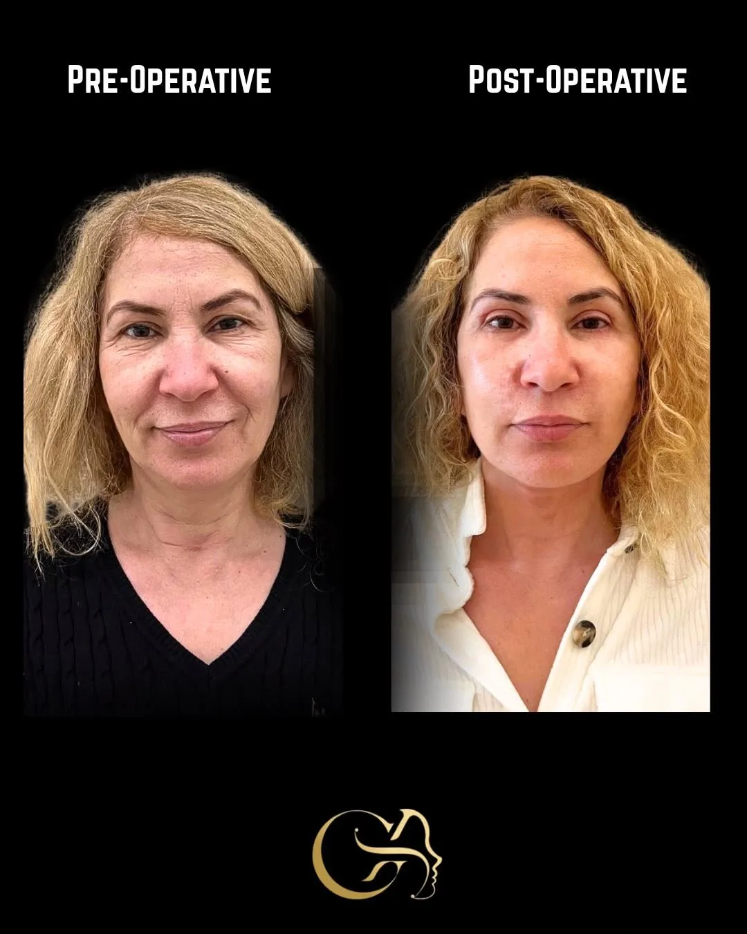 Before and after deep plane facelift — 52-year-old woman, frontal view, 6mo post-op by Dr. Görkem Atsal
