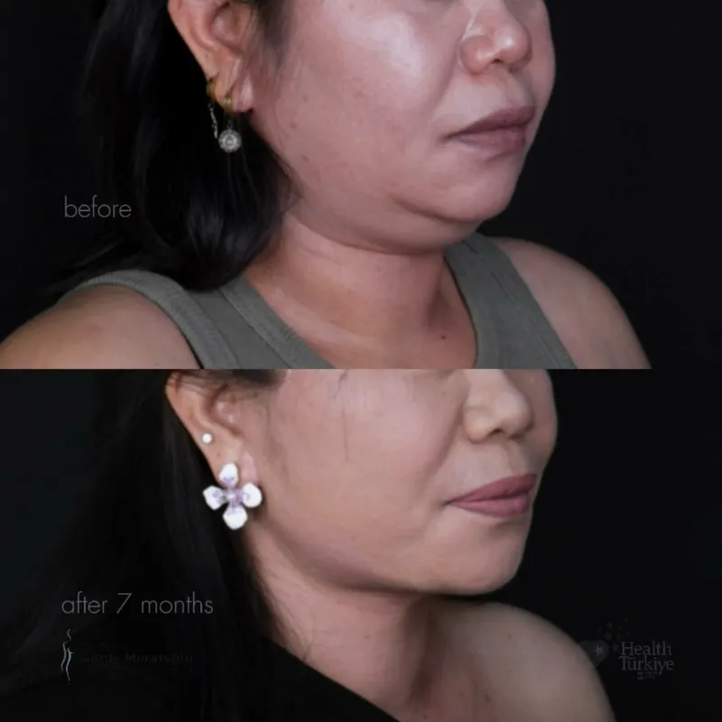 Before and after — Dr. Gözde Muratoğlu