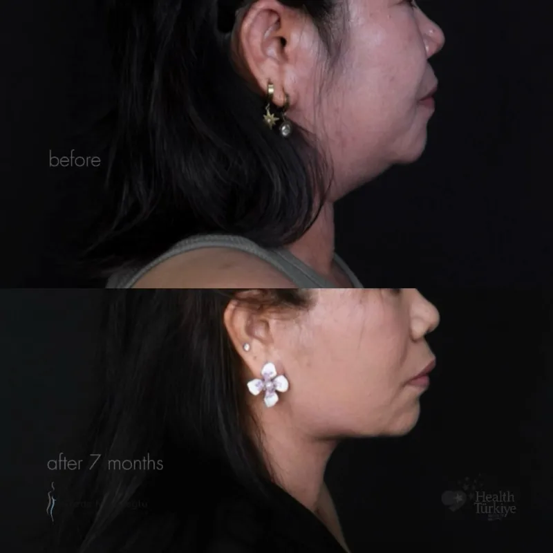 Before and after — Dr. Gözde Muratoğlu