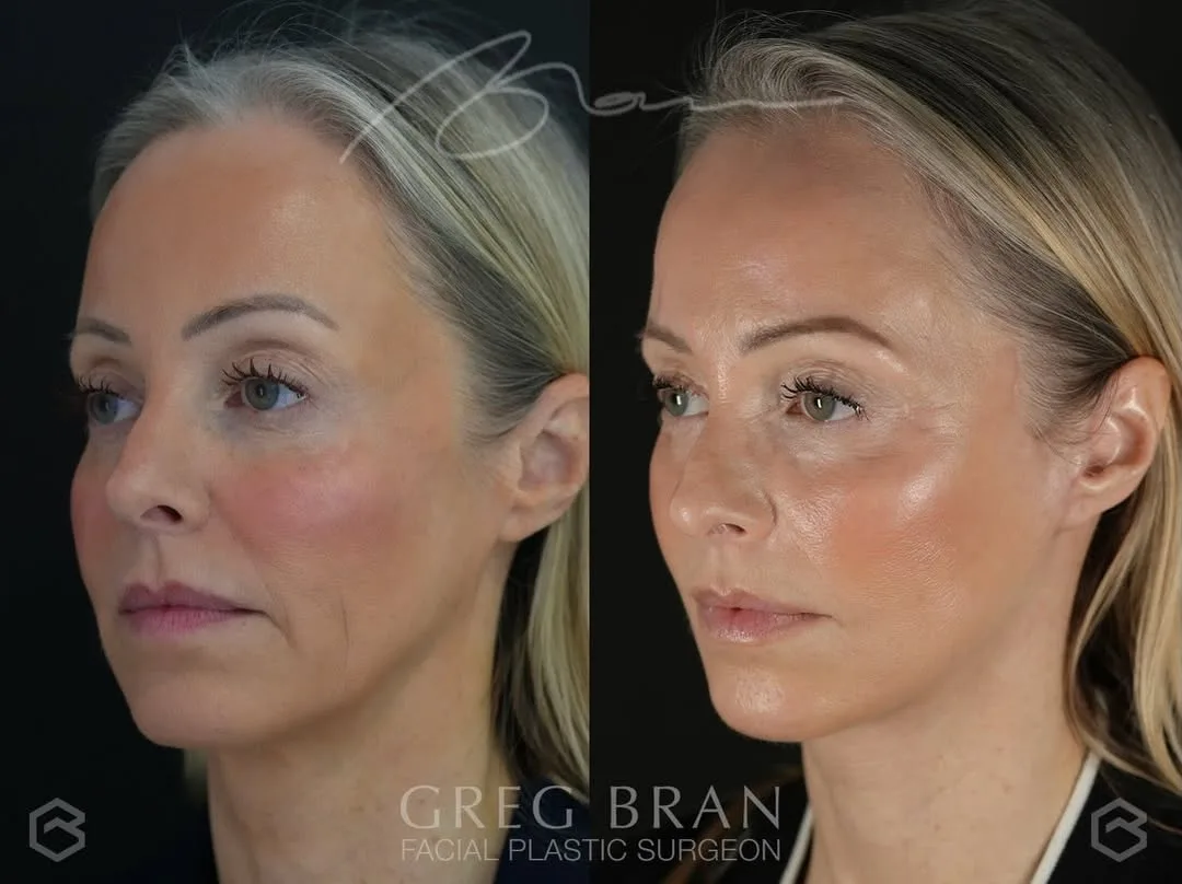 Before and after — Dr. Greg Bran