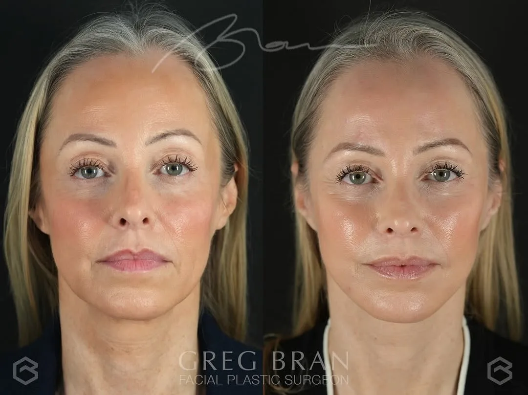 Before and after — Dr. Greg Bran
