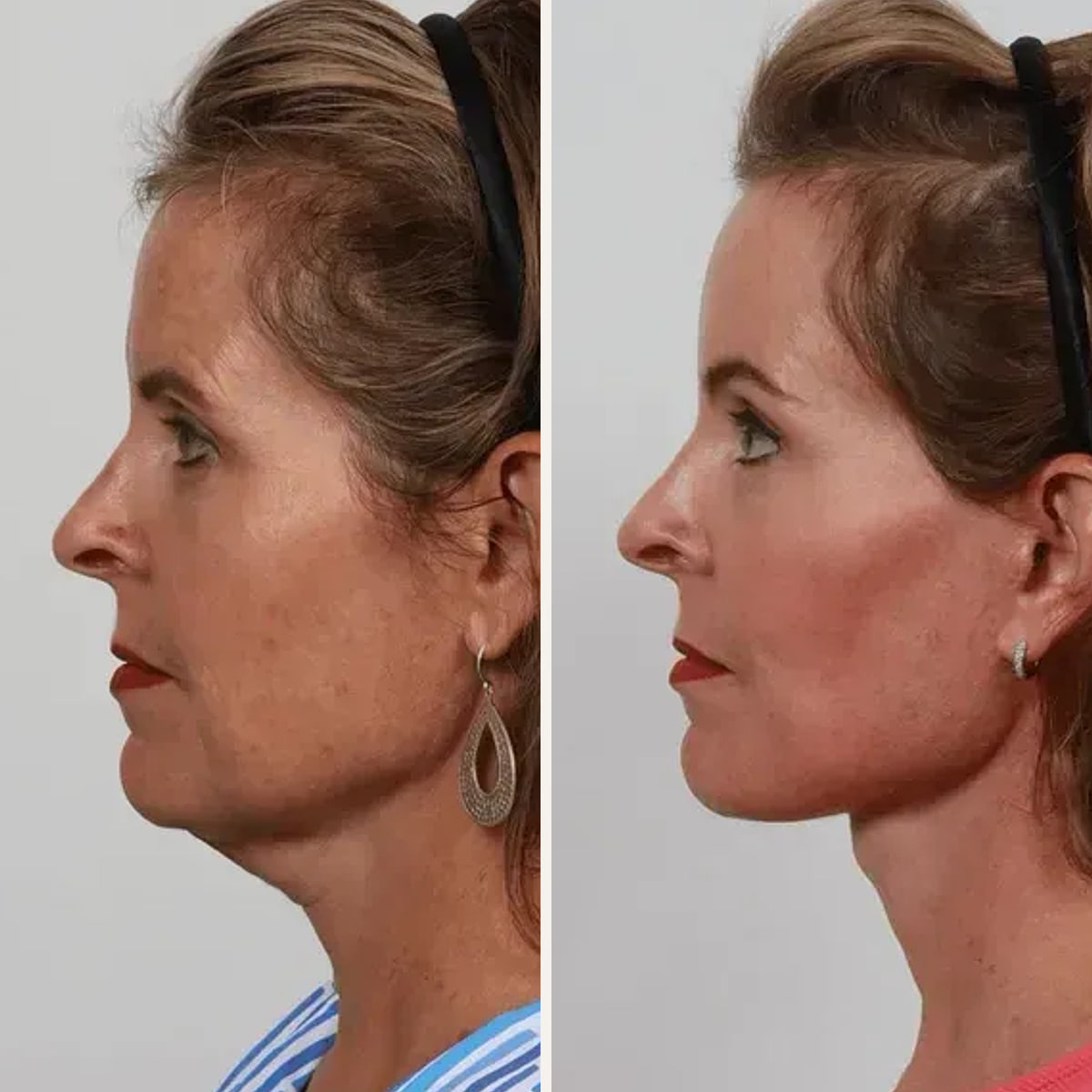 Before and after: Dr. Garrett Locketz