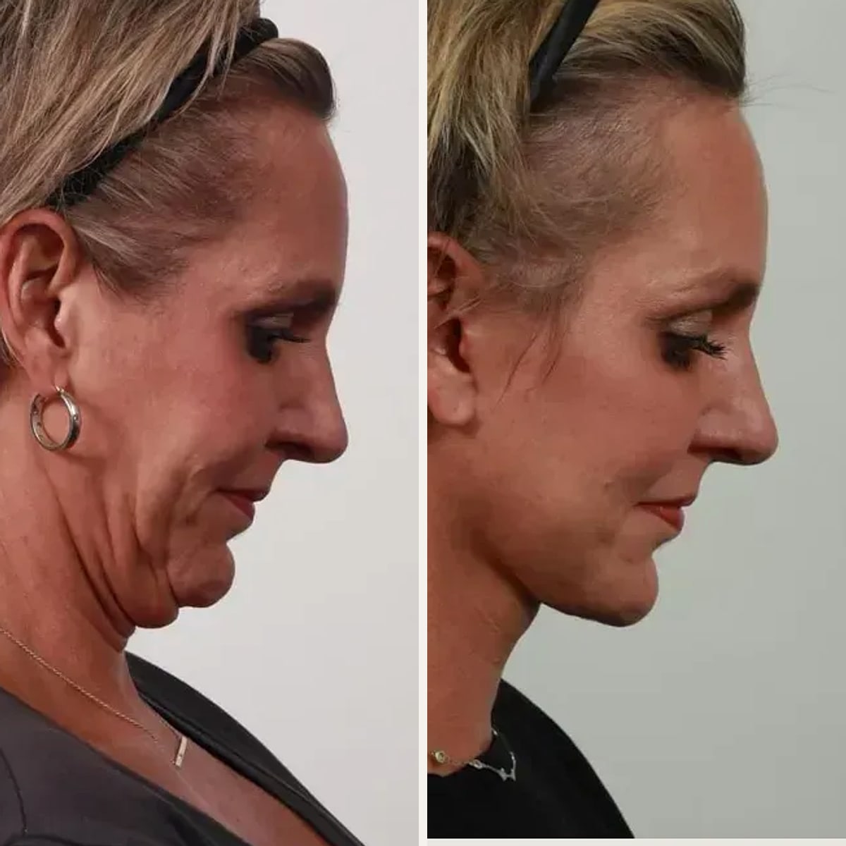 Before and after: Dr. Garrett Locketz