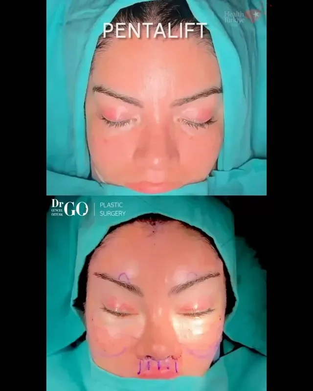 Before and after deep plane facelift, frontal view by Assoc. Prof. Güncel Öztürk