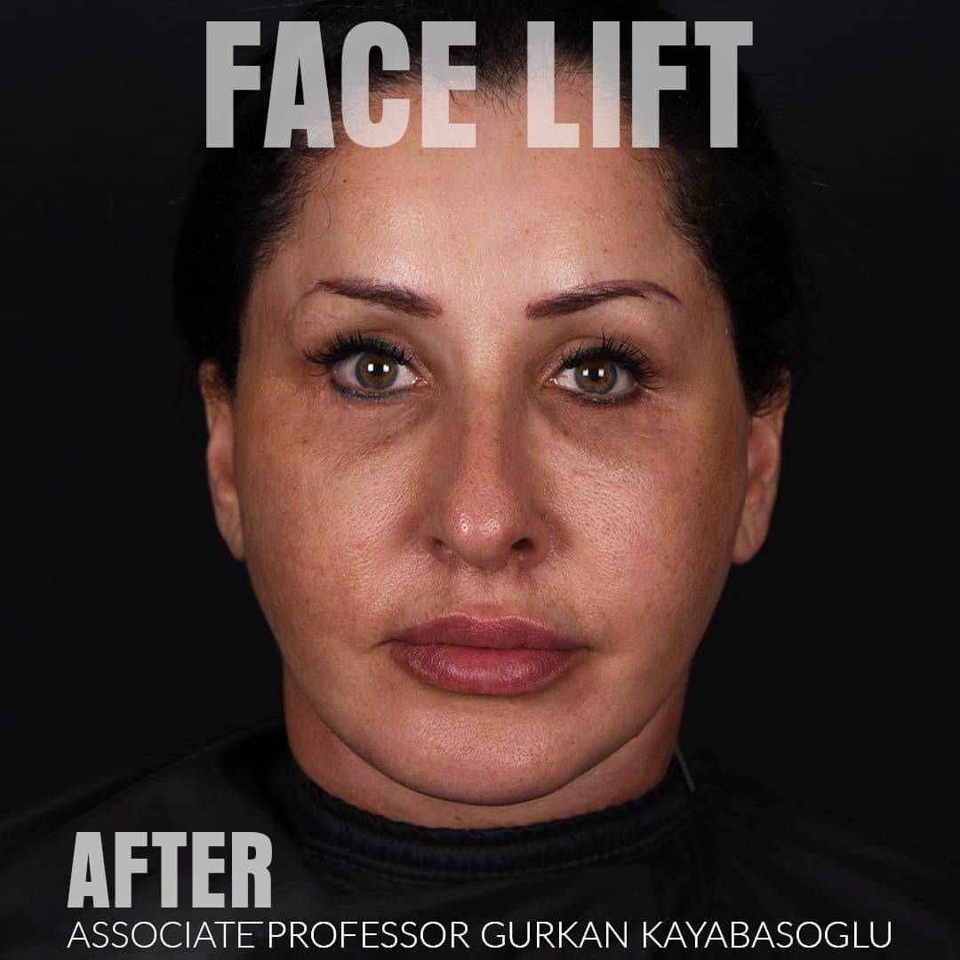 After deep plane facelift — 52-year-old woman, frontal view, 6mo post-op by Prof. Gürkan Kayabaşoğlu