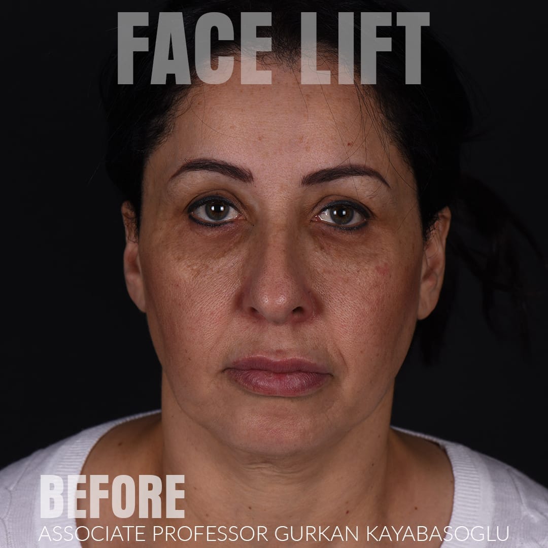 Before deep plane facelift — 52-year-old woman, frontal view, 6mo post-op by Prof. Gürkan Kayabaşoğlu