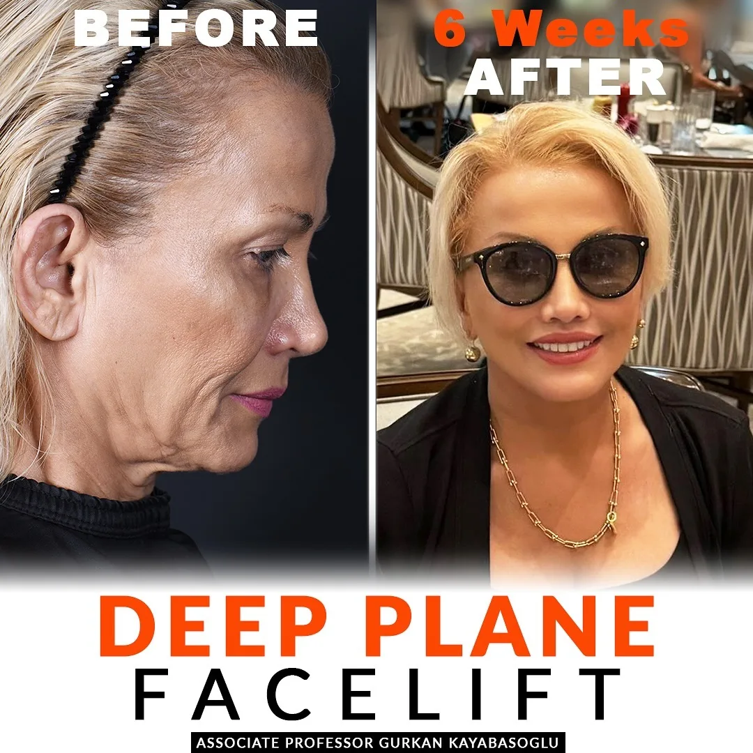 Before and after deep plane facelift — 52-year-old woman, left profile view, 6mo post-op by Prof. Gürkan Kayabaşoğlu