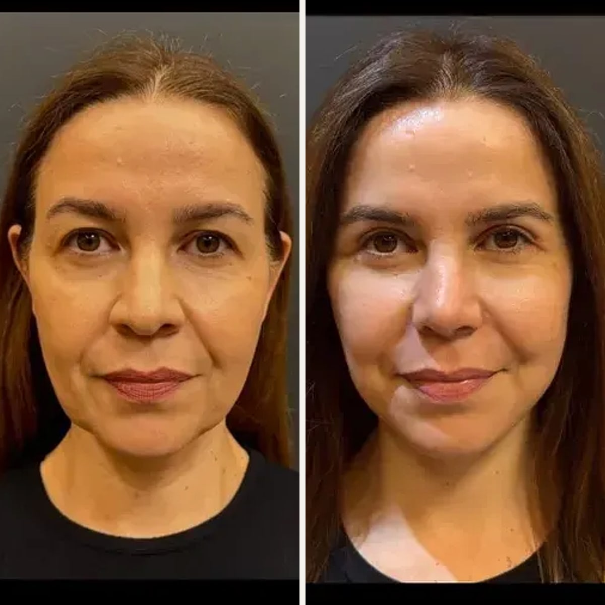 Before and after: Dr. Gustavo Tilmann