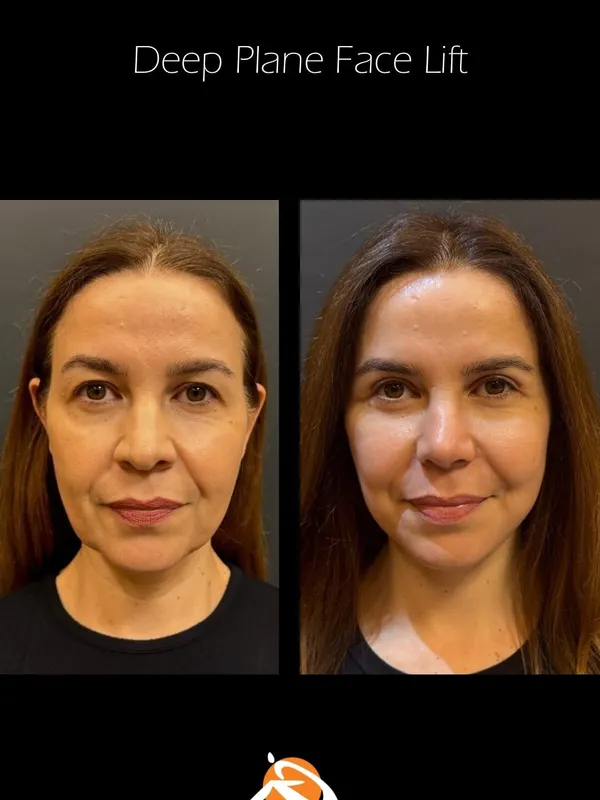 Before and after deep plane facelift, frontal view by Dr. Gustavo Tilmann