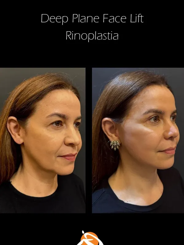 Before and after deep plane facelift, frontal view by Dr. Gustavo Tilmann