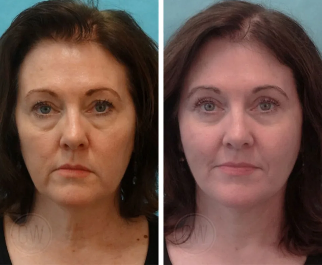 Before and after — Dr. Guy Watts