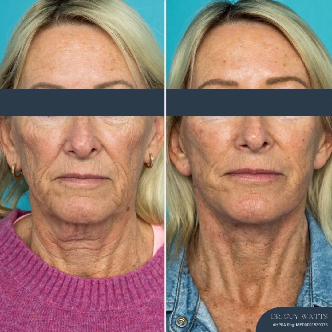 Before and after — Dr. Guy Watts