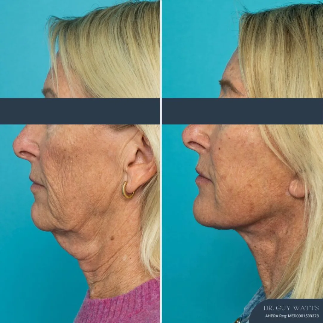 Before and after — Dr. Guy Watts