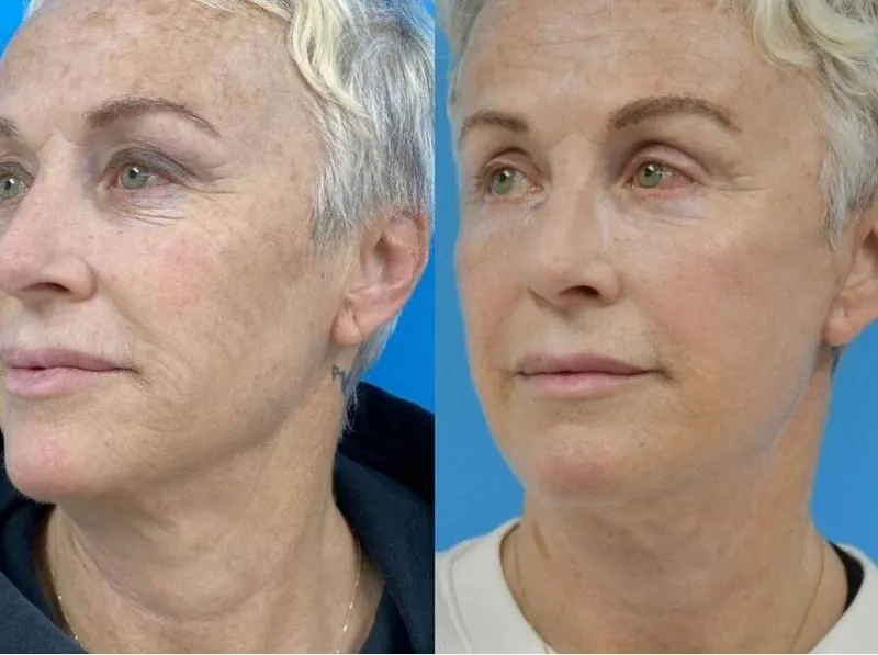 Before and after deep plane facelift — 65-year-old woman, three-quarter view, 3mo post-op by Dr. Hadi Nural
