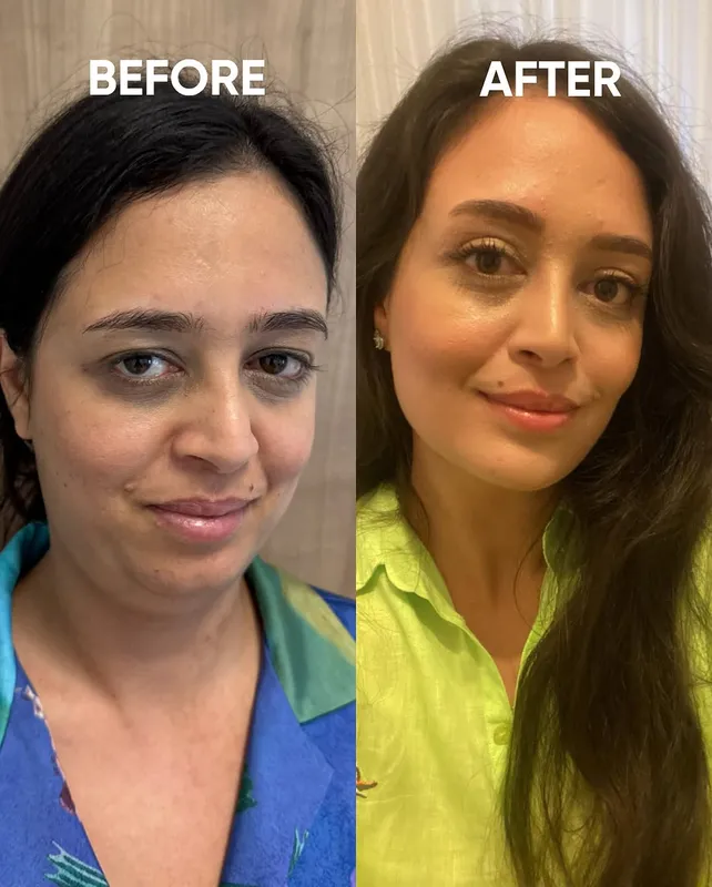 Before and after deep plane facelift — -1-year-old patient, frontal view by Dr. Hakan Gökeri