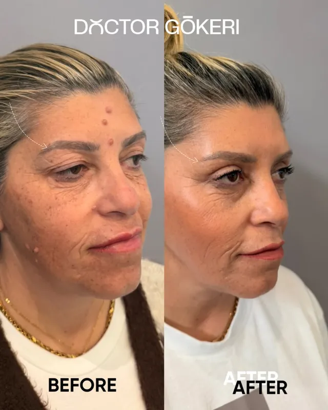 Before and after deep plane facelift — -1-year-old patient, frontal view by Dr. Hakan Gökeri