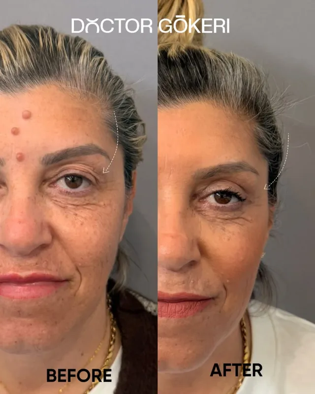 Before and after deep plane facelift — -1-year-old patient, frontal view by Dr. Hakan Gökeri