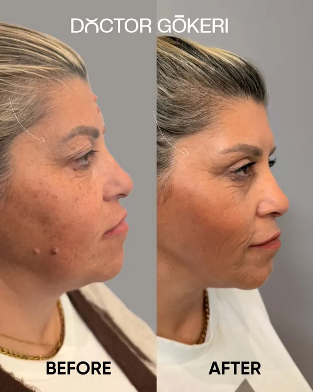 Before and after deep plane facelift — -1-year-old patient, frontal view by Dr. Hakan Gökeri
