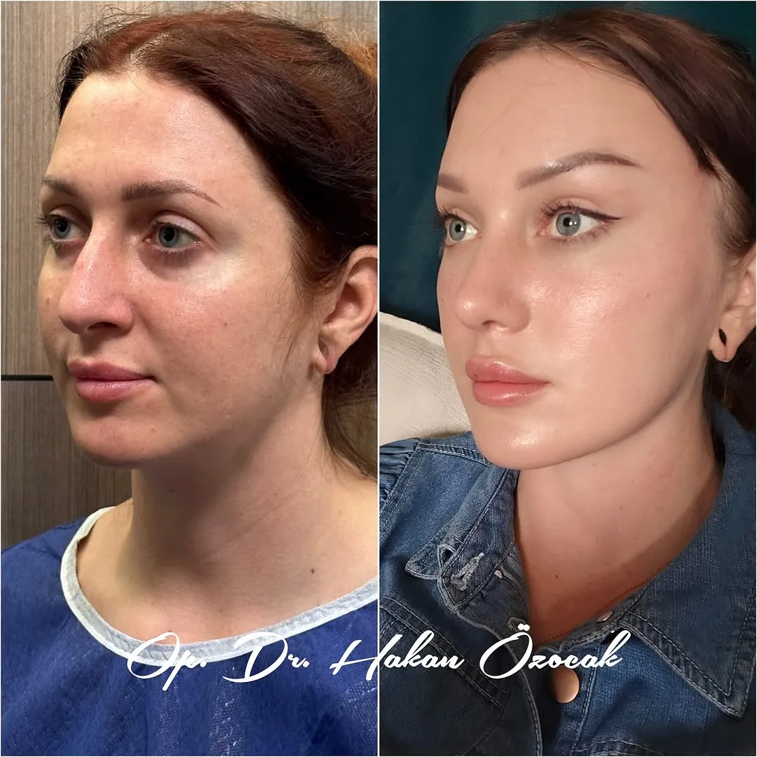 Before and after — Dr. Hakan Özocak