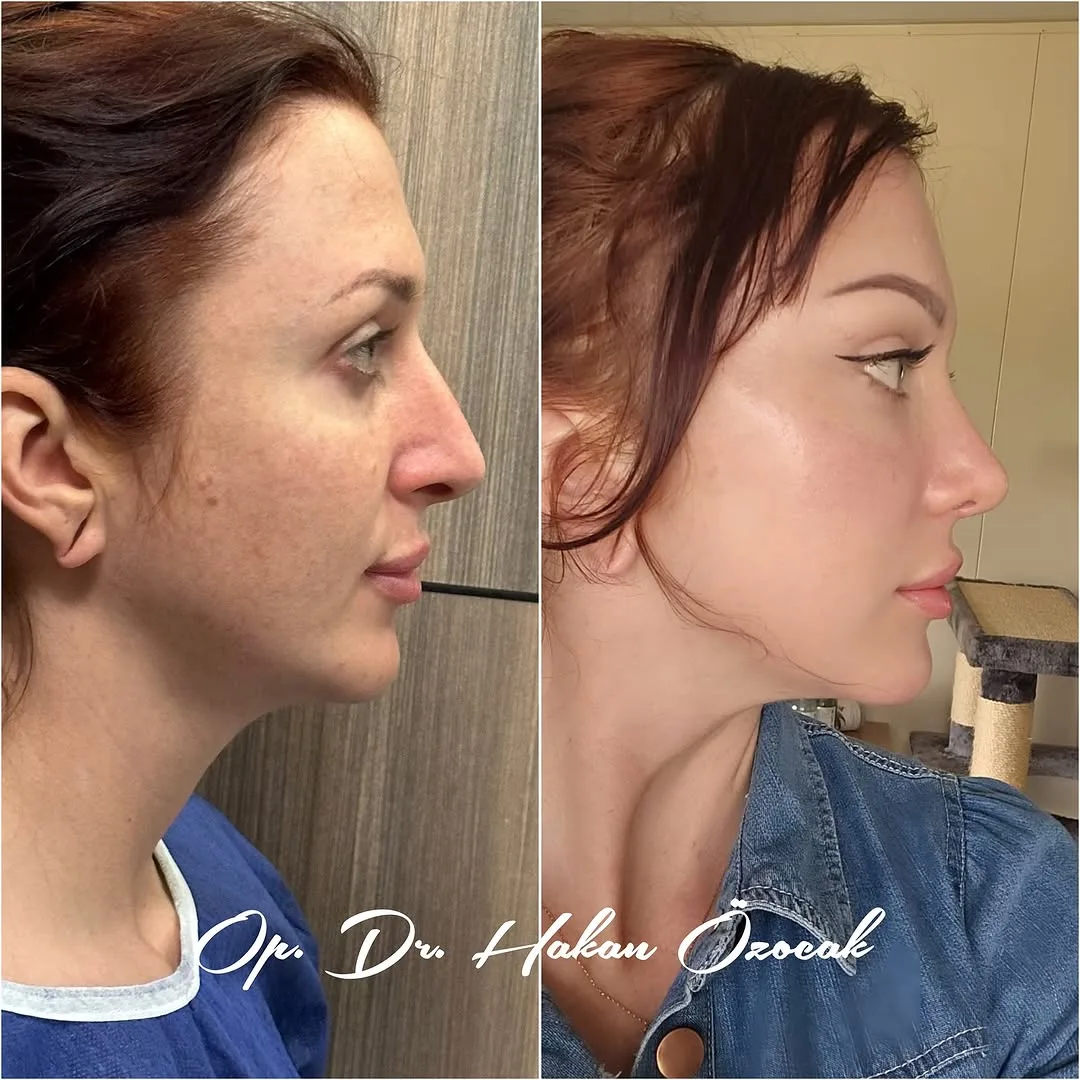 Before and after — Dr. Hakan Özocak