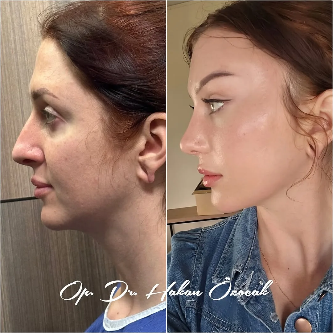 Before and after — Dr. Hakan Özocak