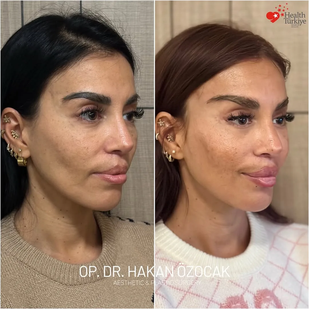 Before and after — Dr. Hakan Özocak