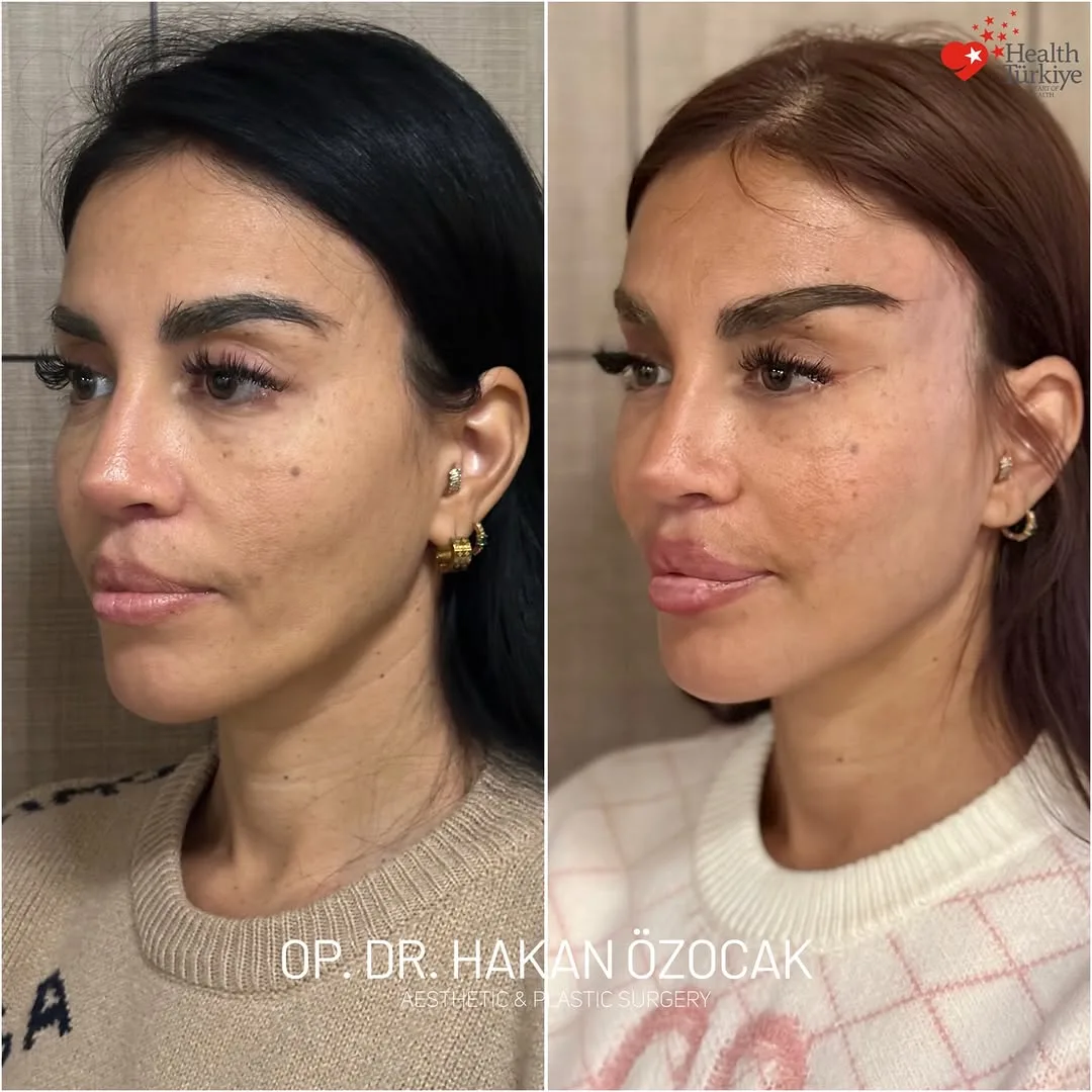 Before and after — Dr. Hakan Özocak