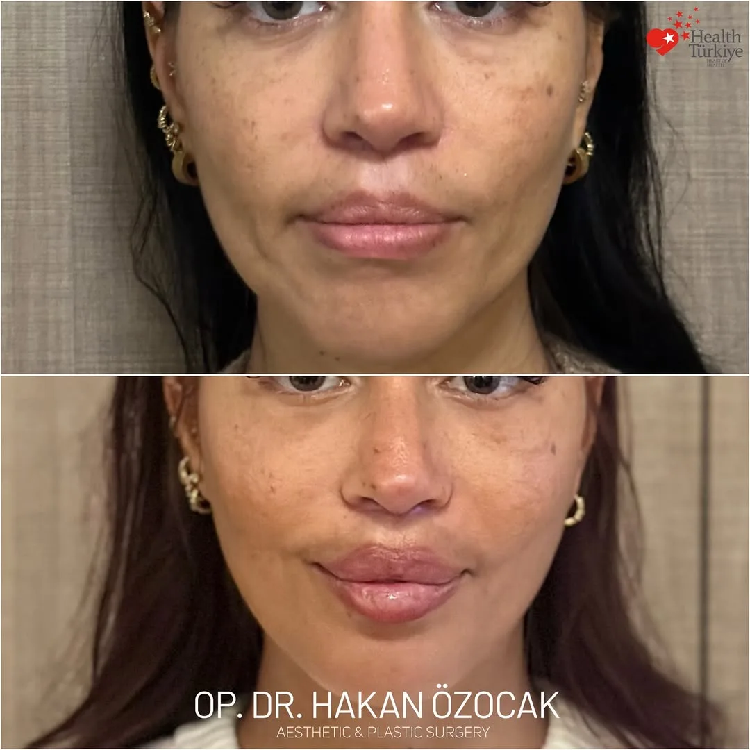 Before and after — Dr. Hakan Özocak