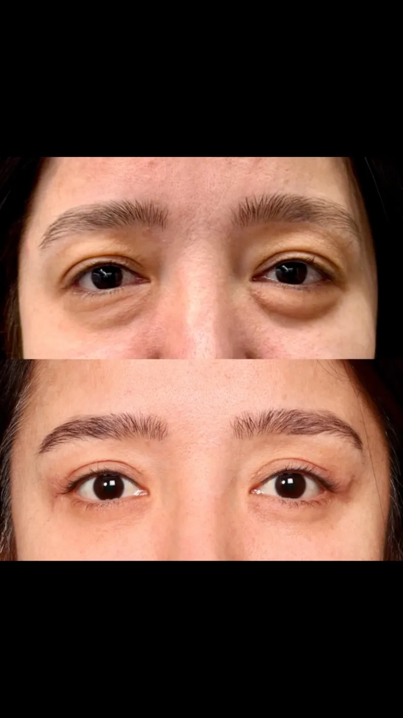 Before and after — Dr. Hakan Şirinoğlu