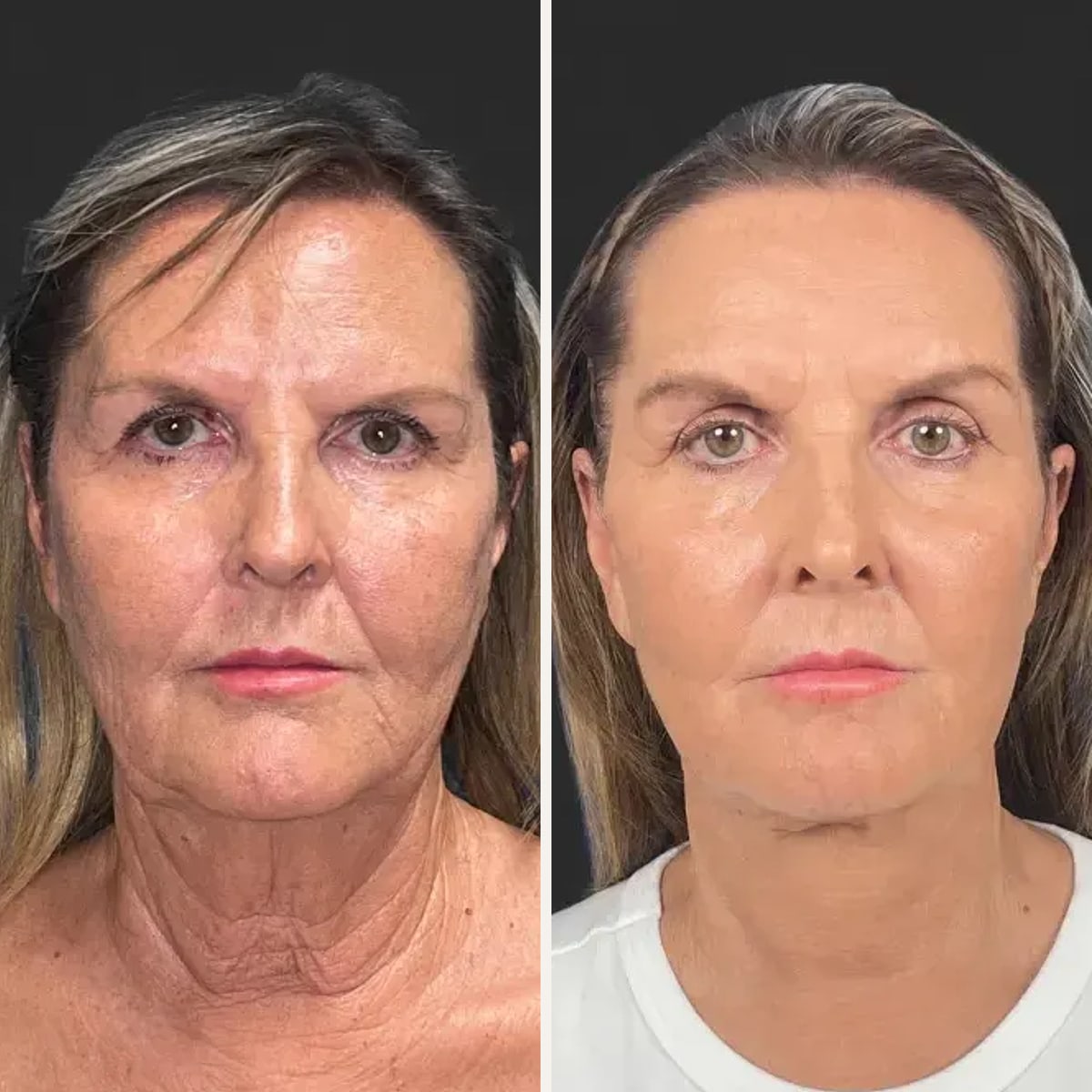 Before and after: Dr. Hani Rayess