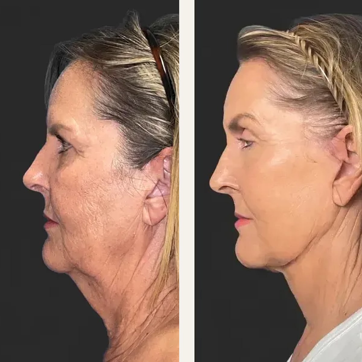 Before and after: Dr. Hani Rayess