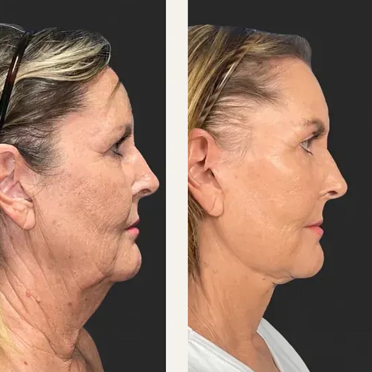 Before and after: Dr. Hani Rayess