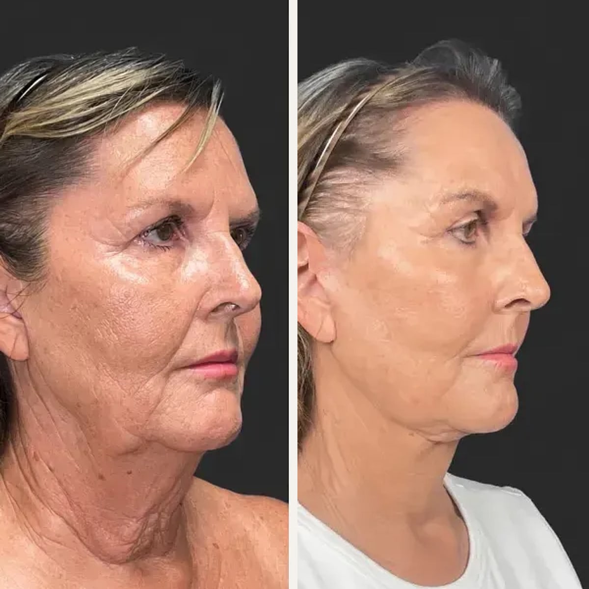 Before and after: Dr. Hani Rayess