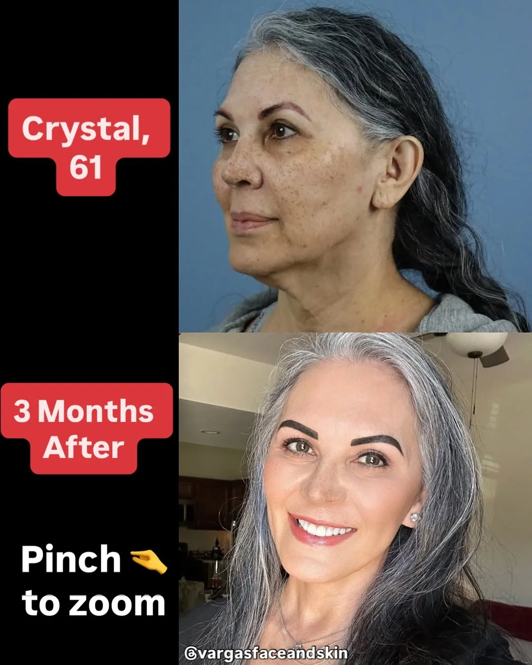 Before and after — Dr. Hannah Vargas