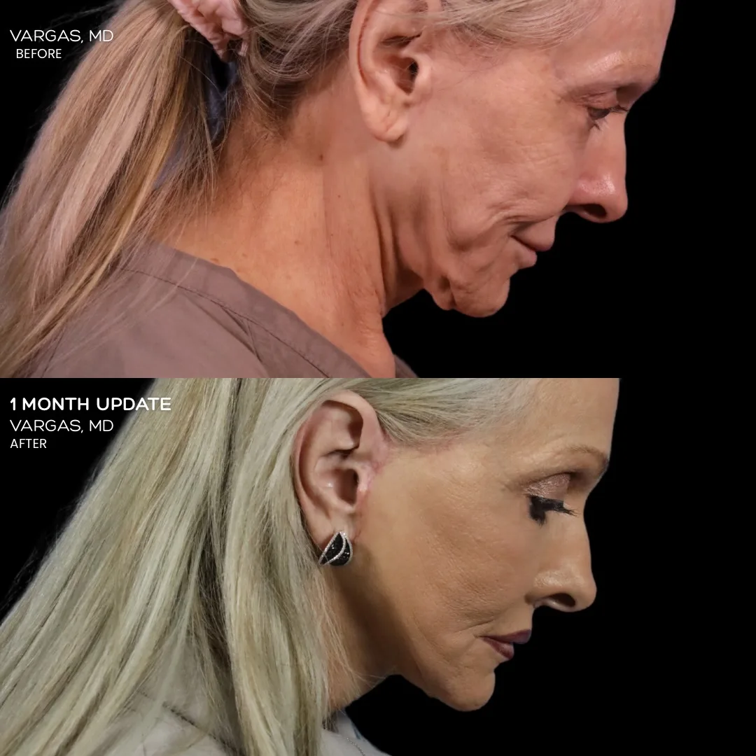 Before and after — Dr. Hannah Vargas
